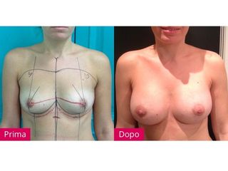 Mastoplastica additiva prima e dopo