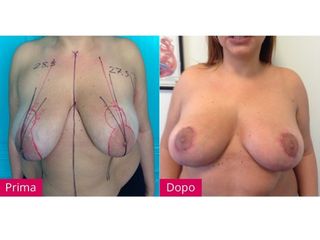 Mastopessi pre e post