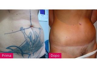 Rimozione tatuaggio prima dopo