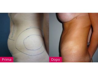 Liposuzione prima e dopo