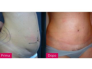 Liposuzione prima e dopo