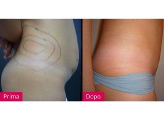 Liposuzione prima e dopo