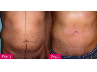 Liposcultura prima e dopo