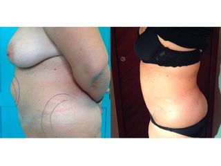 Liposcultura prima e dopo