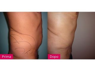 Liposuzione prima e dopo