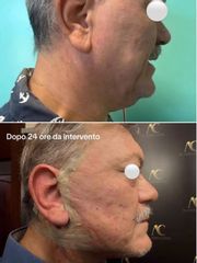 Dottor Alberto Capone Lifting viso