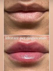 Dottor Alberto Capone Filler Labbra