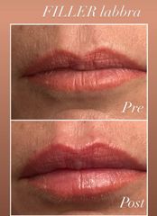 Dottor Alberto Capone Filler Labbra