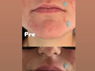 Filler labbra prima e dopo - 877864