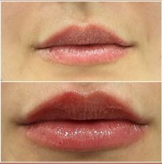 Dottor Alberto Capone Filler Labbra