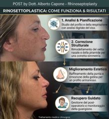 Dottor Alberto Capone Rinosettoplastica come funziona