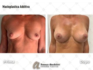 Mastoplastica additiva - Dott. Tommaso Anniboletti