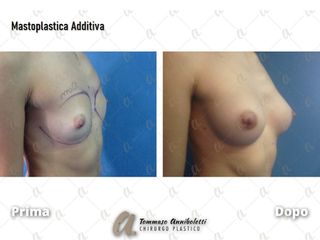 Mastoplastica additiva - Dott. Tommaso Anniboletti