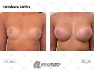 Mastoplastica additiva - Dott. Tommaso Anniboletti