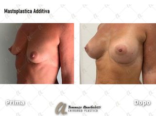 Mastoplastica additiva - Dott. Tommaso Anniboletti