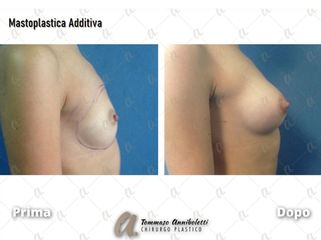 Mastoplastica additiva - Dott. Tommaso Anniboletti