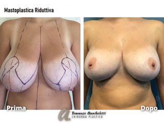Mastoplastica riduttiva - Dott. Tommaso Anniboletti