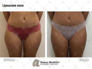 Liposuzione - Dott. Tommaso Anniboletti Chirurgo Plastico