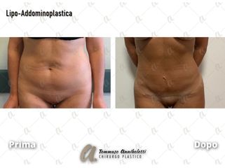 Addominoplastica - Dott. Tommaso Anniboletti Chirurgo Plastico