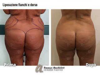 Liposuzione - Dott. Tommaso Anniboletti Chirurgo Plastico