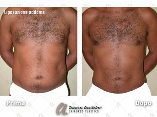 Liposuzione - Dott. Tommaso Anniboletti Chirurgo Plastico