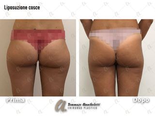 Liposuzione - Dott. Tommaso Anniboletti Chirurgo Plastico
