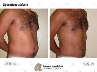 Liposuzione - Dott. Tommaso Anniboletti Chirurgo Plastico