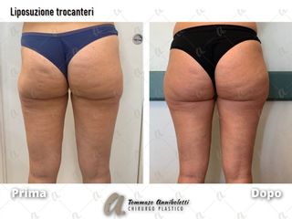 Liposuzione - Dott. Tommaso Anniboletti Chirurgo Plastico