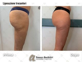 Liposuzione - Dott. Tommaso Anniboletti Chirurgo Plastico