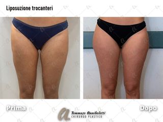 Liposuzione - Dott. Tommaso Anniboletti Chirurgo Plastico