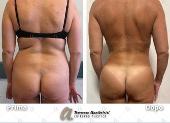 Liposuzione - Dott. Tommaso Anniboletti Chirurgo Plastico