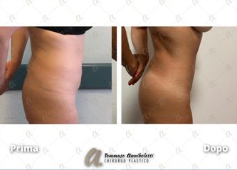 Liposuzione - Dott. Tommaso Anniboletti Chirurgo Plastico