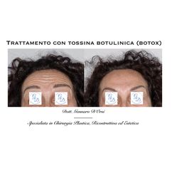 Botox - Dott. Gennaro D'Orsi
