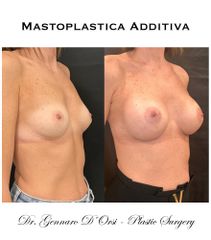 Mastoplastica additiva - Dott. Gennaro D'Orsi