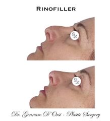 Rinofiller - Dott. Gennaro D'Orsi