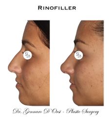 Rinofiller - Dott. Gennaro D'Orsi
