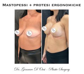 Mastopessi con protesi - Dott. Gennaro D'Orsi