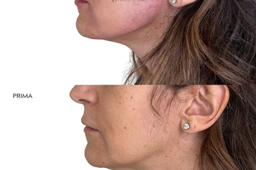Lifting viso prima e dopo - 853828