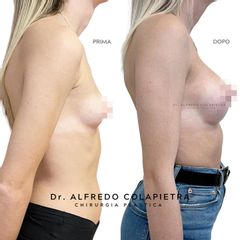 Mastoplastica additiva - Dott. Alfredo Colapietra