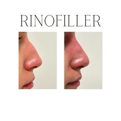 Rinofiller - Dott. Giovanni Migliorini