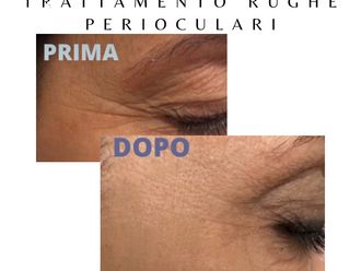 Botulino prima e dopo - 877743