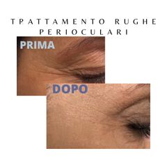Dott. Giovanni Migliorini Botox rughe perioculari