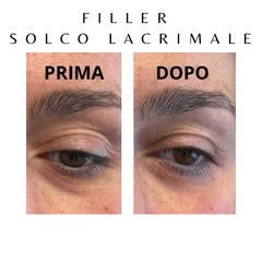 Dott. Giovanni Migliorini Filler Solco Lacrimale