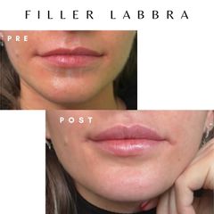 Dott. Giovanni Migliorini Filler Labbra