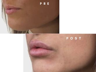 Filler labbra prima e dopo - 877789