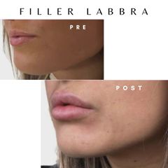 Dott. Giovanni Migliorini Filler Labbra