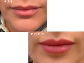 Filler labbra prima e dopo - 877790