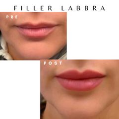 Dott. Giovanni Migliorini Filler Labbra