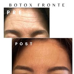 Dott. Giovanni Migliorini Botulino