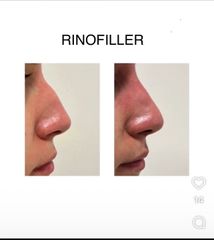 Dott. Giovanni Migliorini Rinofiller